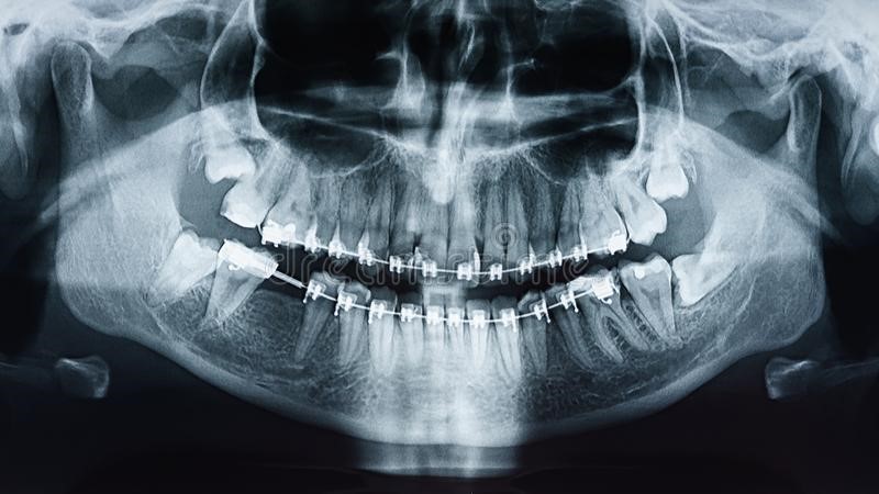 تفاوت RVG و OPG در تصویر برداری دندان چیست؟