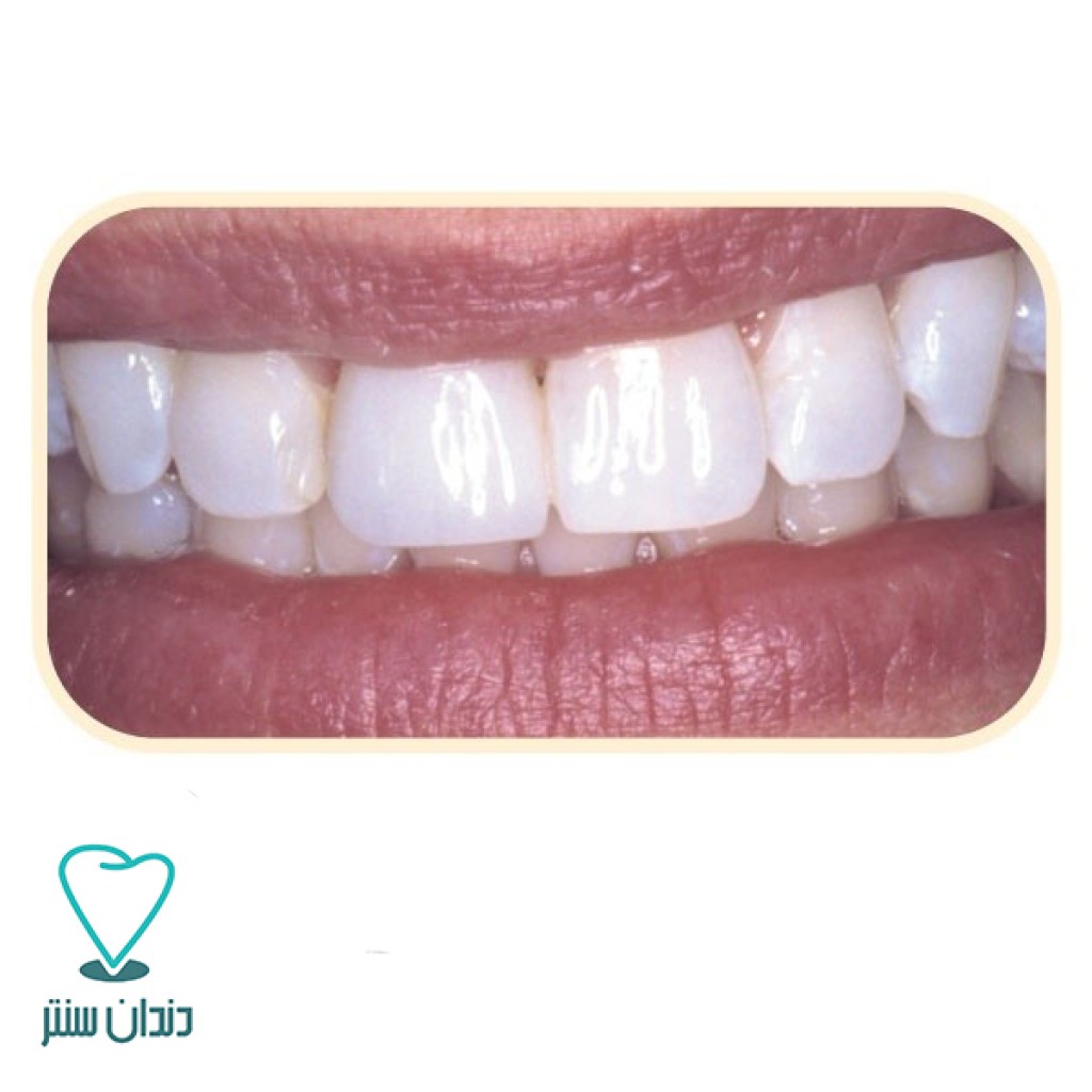 خمیر پرداخت کامپوزیت اناملایز کازمادنت / Cosmedent Enamelize Polishing